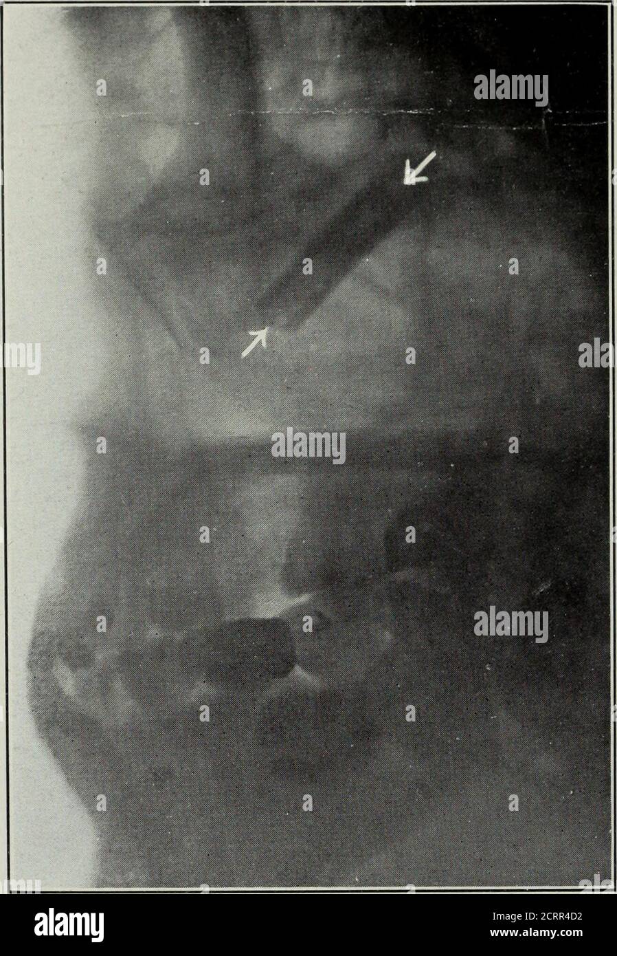 . Elementare und zahnärztliche Radiographie . Abb. 278. Gleicher Fall wie Vlg. 277 nach Entfernung des Zahnwurzelstückes. (Röntgenaufnahme von Carman, St. Louis.) Dr. Crxer sagt oi VG. 2/^). li is niad«^Tifl. 279. Von einem Patienten, der einige Zeit im maxil- lary Sinus tor eine Unruhe hatte. Das Bild dämonisch-striert, dass ein Stück Ruhher Tuhing, die heen für die Drainage verwendet hatte, hatte in das Antrum rutschte und hccc^me in der Region theostium maxillare untergebracht. Nach seiner Entfernung und einer l^Rief-Behandlung, die Parthecame gut. 242 ZAHNRADIOGRAPHIE. Abb. 279. Die Pfeile zeigen auf ein Stück Gummischlauch in der Ameise Stockfoto