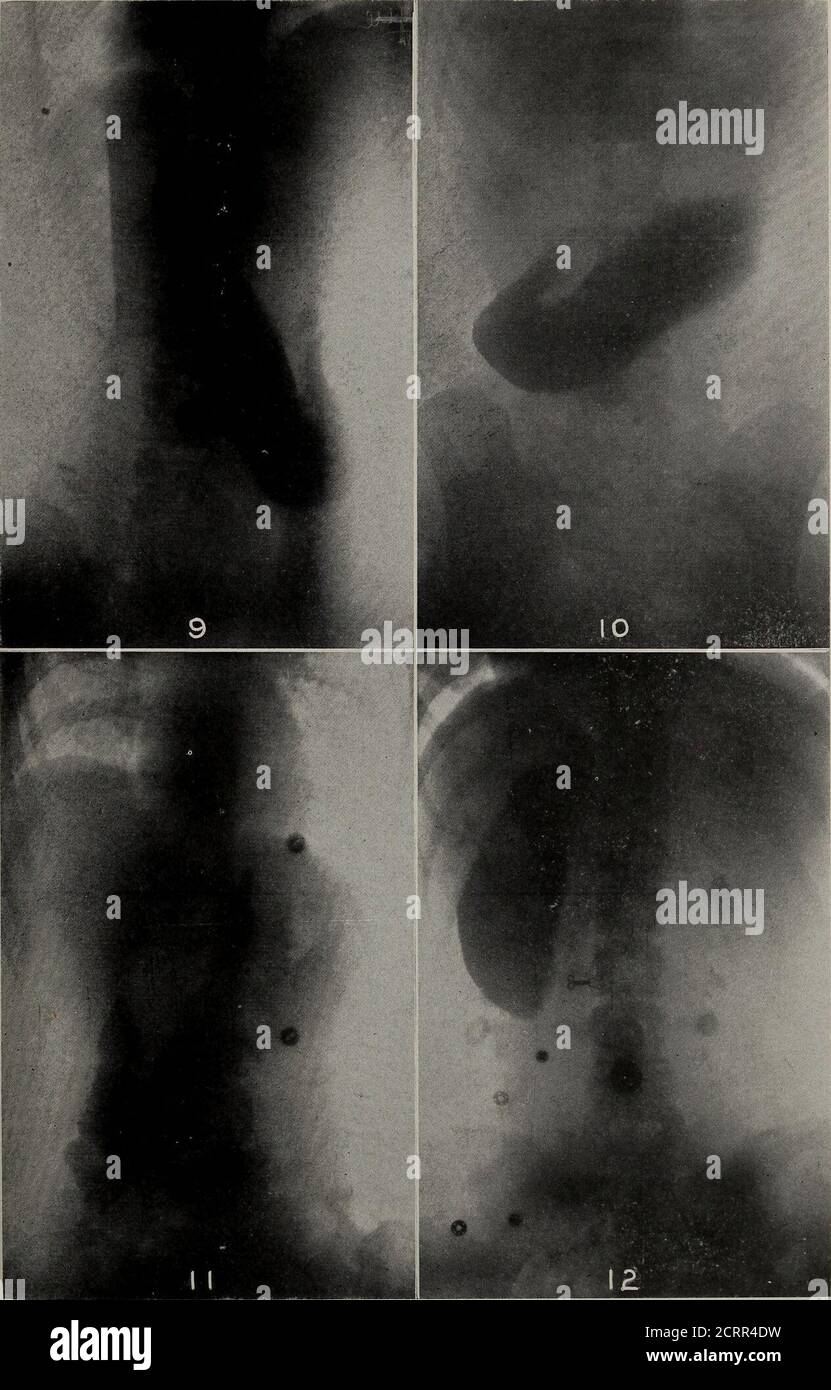 . American vierteljährlich von roentgoenology . illedwith Bismut. Stehend, kam der kaudale Pol zu den Fingernäpfchen unter dem Nabel herunter. (Nein 11.) Patient ein Mädchen, AET. 14, auf dem Bauch liegend. Dorso-ventrale Exposition. Beachten Sie die ungewöhnliche Form dieses Stom-Achs, mit seiner schraubenartigen Drehung und scheinbar durchbrechen Mitte von Peristalsis. Der kaudale Pol befindet sich auf einer Ebene mit dem unteren Rand des 5. Lendenwirbels. Stand-ing, kommt es unten (orthodiagraphic Untersuchung) tofour Finger breadths unter dem Nabel. Dieselbe Patientin auf ihrem Rücken. Ventro-dorsale Exposition.der Magen ist etwas höher als bei Nr. 1 Stockfoto