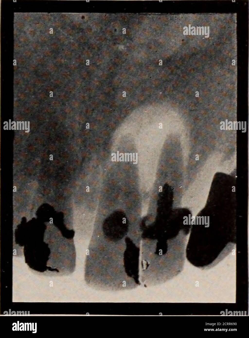 . Zahnärztliche und orale Radiographie : ein Lehrbuch für Studenten und Praktiker der Zahnmedizin . Abb. 57. Unterhalb der mesialen Wurzel des Alower molar ist ein sehr großer alveolarer Abszess sichtbar. Abb. 58. Ein alveolarer Abszess, der die Wurzeln eines oberen zentralen Inzisors und eines lateralen Inzisors umfasst. In beiden Zähnen sind keine Wurzelkanalfüllungen vorhanden. 13(3 DENTAL AXD ORALE RADIOGRAPHIE Laubzähne können leicht bestimmt werden, siehe Abb. 55 und 56. Gebrochene Wurzeln oder Brüche des Hone sogar Stockfoto