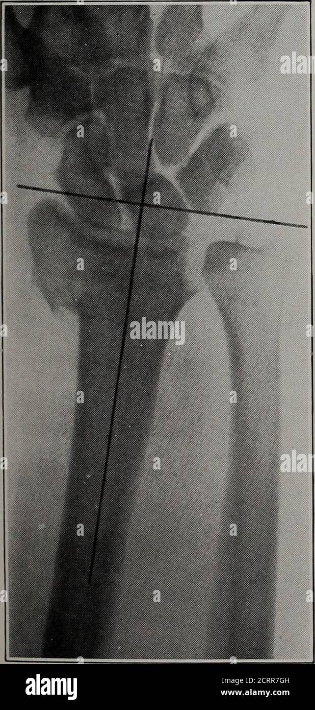 . American vierteljährlich der Roentgoenology . Nr. 7. Nr. 8. Gebrochener Radius. Beachten Sie, dass das Styloid des Radius proximal zur Querlinie ist, was auf eine rückwärtige und aufwärts gerichtete Disposition des radialen Kopfes hinweist. Die lange Achse des Radius verläuft nun zwischen dem dritten und vierten Mittelhandknochen durch die Rotation der Hand und des Karpalbereichs mit dem verdrängten Radialkopf. Nr. 8 Stockfoto