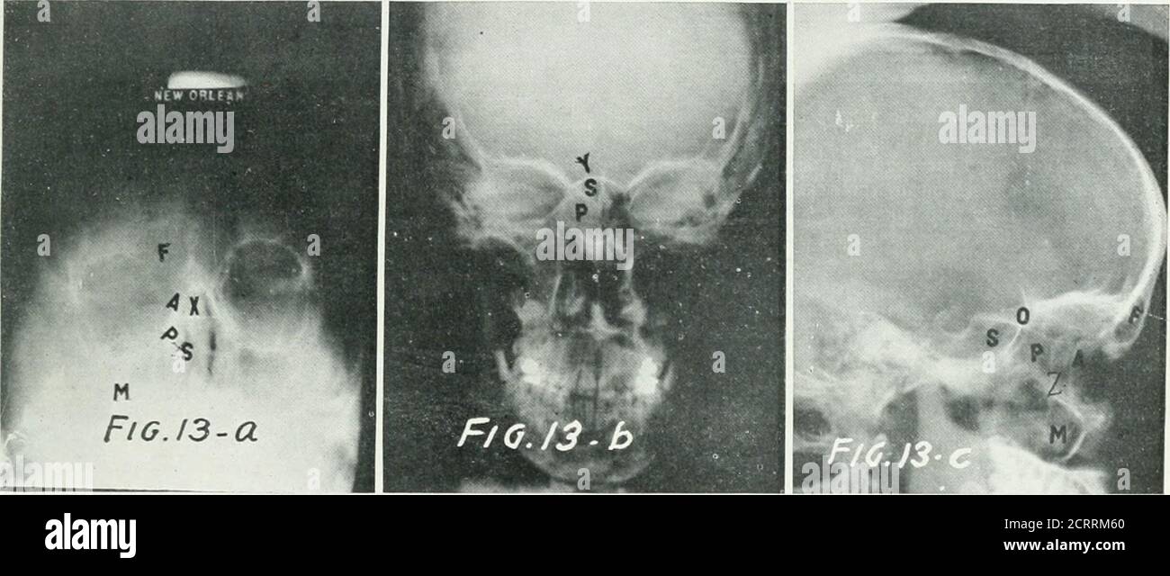 . Archive der Physikalischen Medizin und Rehabilitation . Wig. 12 – Left Fided Chronic Sphenoid und ethmoide Sin-usitis mit Polypoiden. Erhöhte Dichte der linken. Abb. 13 – chronische Pan-Sinusitis auf der riffht srig-ht Seite der Linie Y ist sehr stark thicke die Sphenoid SinuT, die Ethmoidschalen und der maxil-lary Sinus sind alle auf der rlgfht Seite sehr deckend. Stockfoto