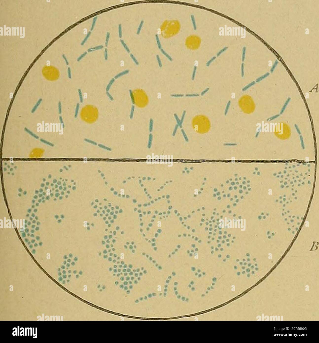 . Eine praktische Abhandlung über die medizinische Diagnose für Studenten und Ärzte. Der liquefyinggelatine ist weiß. 3. Staphylococcus epidermidis albus (Welch) simuliert eng Staphy-lococcus pyogenes albus. Es ist der häufigste Mikroorganismus auf der Oberfläche des Körpers, und ist oft in Teilen der Epidermis toodeep zur Desinfektion vorhanden, sparen durch Hitze. Es soll die übliche Verdammung von Stichabszess sein. 4. Streptococcus Pyogenes. Es wird bei akuten Abszesse, Erysipeln, Otitis media, puerperaler Metritis, infektiöser Endokarditis, Pseudodiphtherie, Scarlatinalangina und eitriger Entzündung gefunden Stockfoto