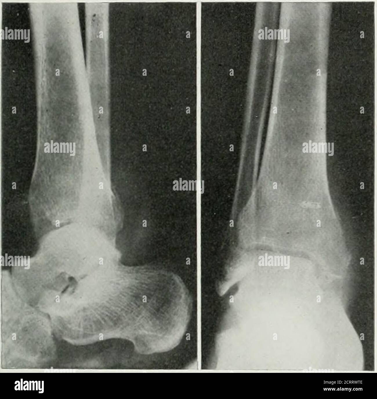 . Die amerikanische Zeitschrift für Roentgoenology, Radium-Therapie und Nuklearmedizin . *Abb. 4. Zeigt DIE .mikroskopische .iiEAKANCE des Wachstums .s erscheint OX .Künstliche Kulturmedien. * Platten gefvirnished von Dr. Charles W. Bonynge, Bakteriologe, Los Angeles, Calif. Coccidioidale Granulom 549 Hilfe mit der Bohnenernte, meist als athrende Hand. Sein Allgemeinzustand verschlechterte sich rapidlysund seine Temperatur erhöhte sich auf 101,2 Grad am Nachmittag mit einer morgendlichen Temperatur in der Regel um 99 Grad und 100 Grad.die Pulsfrequenz erhöhte sich von 90 auf 120 vor der Operation, durchgeführt von Dr. R. am 15,1916. Februar, wenn ein c Stockfoto