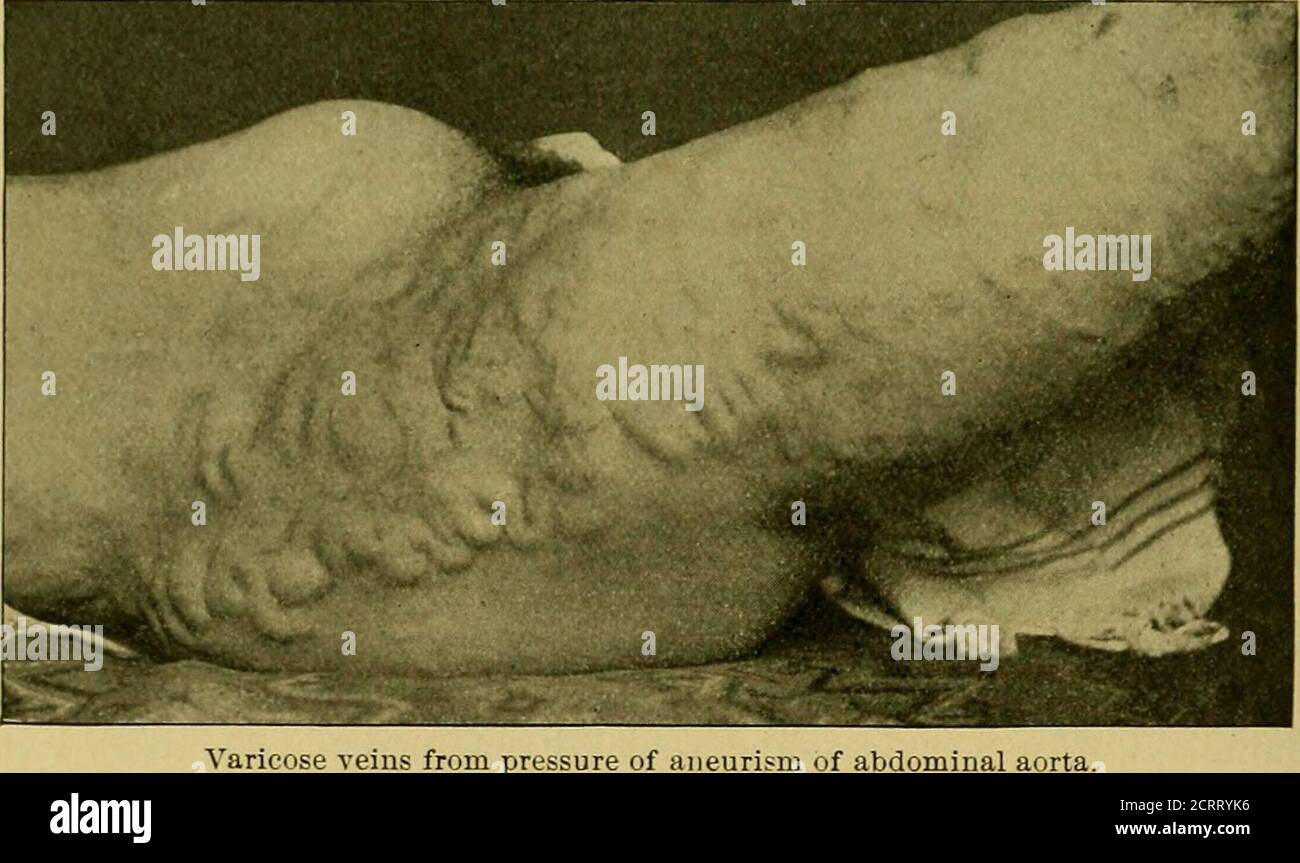 . Eine praktische Abhandlung über die medizinische Diagnose für Studenten und Ärzte . der Medianlinie. Die Pulsierung der Leber, die vaskulären Ursprungs und damit synchron mit der Herzpulsation ist, ist im Leberbereich bei der Erweiterung des rechten Herzens seenin. Magen- und Darmbewegungen. PeristaMc Bewegung, ob der Magen, oder des großen oder Dünndarms, kann durch die Bauchwände sichtbar sein. Bei der Magendilatation und Gastroptose kann man die Wellen in rhythmischer Abfolge von links nach rechts im Bauchraum beobachten. Ihr allgemeiner Kurs ist normalerweise von den Leftup Stockfoto . Eine praktische Abhandlung über die medizinische Diagnose für Studenten und Ärzte . der Medianlinie. Die Pulsierung der Leber, die vaskulären Ursprungs und damit synchron mit der Herzpulsation ist, ist im Leberbereich bei der Erweiterung des rechten Herzens seenin. Magen- und Darmbewegungen. PeristaMc Bewegung, ob der Magen, oder des großen oder Dünndarms, kann durch die Bauchwände sichtbar sein. Bei der Magendilatation und Gastroptose kann man die Wellen in rhythmischer Abfolge von links nach rechts im Bauchraum beobachten. Ihr allgemeiner Kurs ist normalerweise von den Leftup Stockfoto