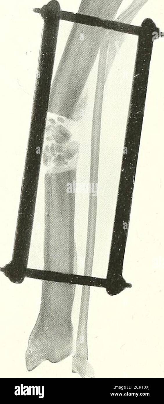 . Über moderne Methoden der Behandlung von Frakturen . a b c Abb. 83. – Skiageams von Katzen Tibias, mit Fragmenten gepfropft. A). Nr. 8C, nach 49 Tagen. Einzeltransplantat in Form eines intramedullären Wirbses. (5). Nr. 88, nach 16 Tagen, mit getrennten Fragmenten. (f). Nr. 89, nach 70 Tagen. Die Chips sind immer noch Qnite diskret. Experimente zum Füllen eines Knochendefekts durch ein einzelnes Großpiece oder durch viele kleine Chips. (Iable XVII, S. 173.) – Diese Experimente sind noch nur drei an der Zahl, und so nicht sehr schlüssig, aber sie sind interessant, soweit sie gehen. Alles in allem wurde das Geleg im Transfixionsapparat aufgesetzt. In der Fi Stockfoto