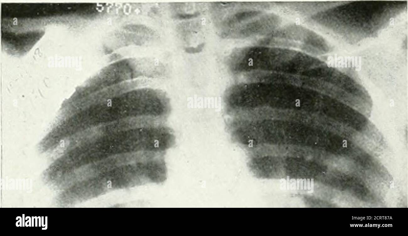 . Die amerikanische Zeitschrift für Roentgoenologie, Radiumtherapie und Nuklearmedizin. Io-ie-14sli TAG oderflue Abb. I. der Ausgangsfilm zeigt das Vorhandensein einer hämorrhagischen Pneumonitis in den angrenzenden Teilen der oberen und unteren linken Lappen sowie in den angrenzenden Teilen der unteren und mittleren rechten Lappen. Man bemerke, dass die Dichte am Hilum am intensivsten ist und in Richtung Peripherie vergeht. Beachten Sie die Klarheit der costophrenischen Winkel auf der rechten und linken Seite.. Stockfoto