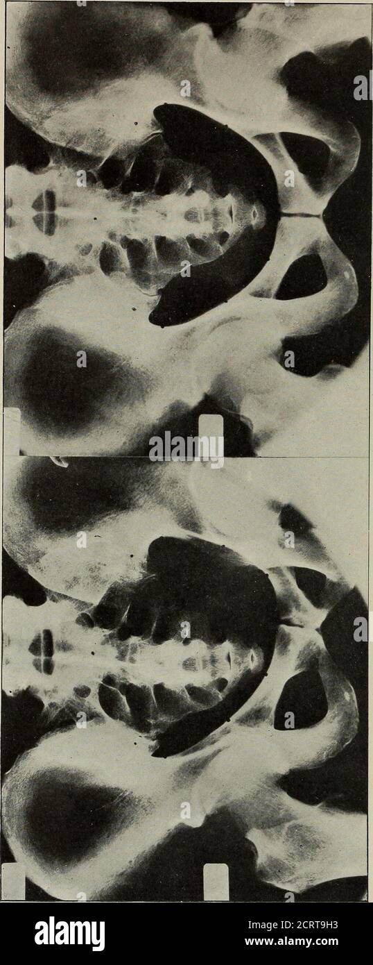 . American vierteljährlich der Roentgoenology . 6. Markierungen auf Beckenbrim.. Oh o Manges: Pelvimetry 4:&gt; Außerdem würde es nur wenige Generationen benötigen, um angehende Mütter zu edu-cate, um zu einer solchen Maßnahme zu einer zeitlang neu konzipierten Zeit zurückzugreifen. Wir würden dann folgern, daß genaue Pelvimetrie sehr zu wünschen ist; daß in der hier beschriebenen Methode wehave accuracy; und daß mit moderner Ausrüstung und Pro-per-Technik der Prozeß frei von Gefahr ist. DISKUSSION. DR. GEORGE H. STOVER, DENVER, COLORADO. Ich betrachte das Stereoradiogramm als die einzig richtige Messart, und ich bin froh, dass Dr. Manges h Stockfoto