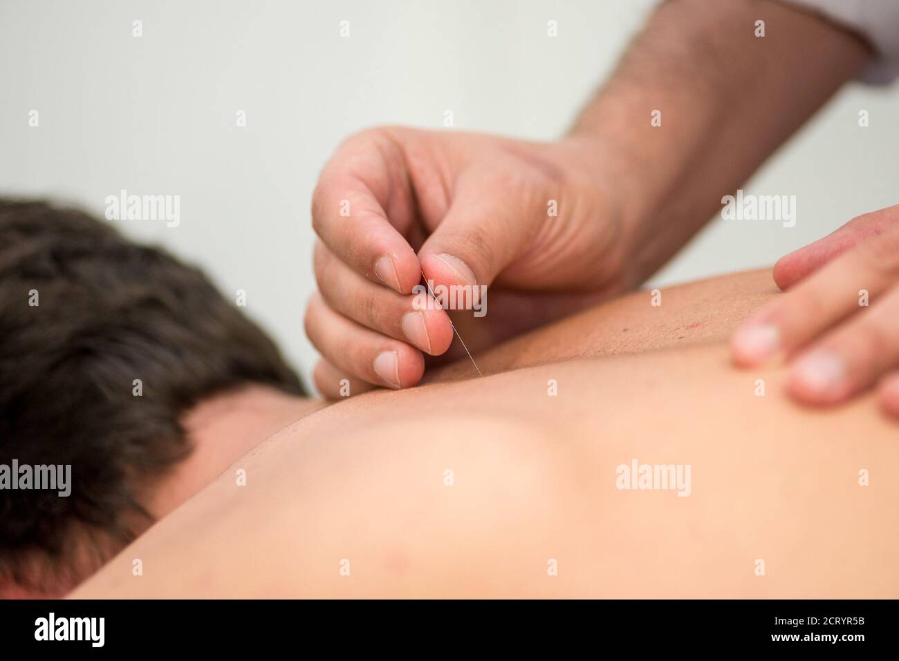 Anwendung von Akupunkturnadeln auf dem Rücken des Patienten Stockfoto