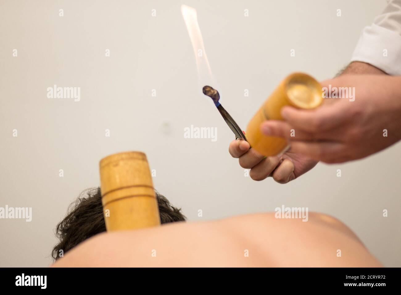 Detail der Anwendung von Akupunktur ree auf dem Rücken eines Patienten Stockfoto