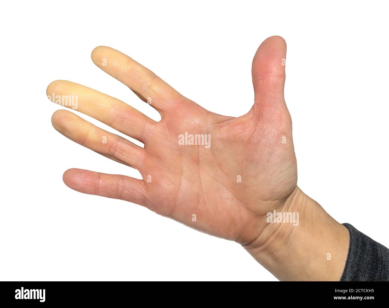 Hand mit Raynaud-Syndrom, Raynaud-Phänomen oder Raynaud-Erkrankungen. Weibliche Hand. Die Finger wurden wegen mangelnder Durchblutung weiß (Pallor). Stockfoto