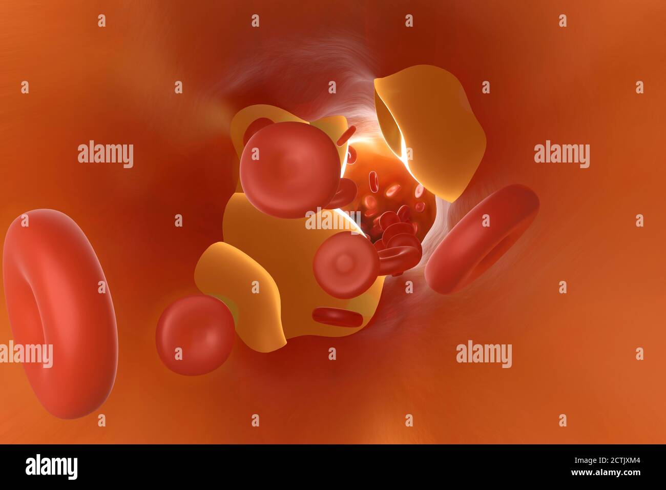Dreidimensionale Darstellung der Arterie, die durch Cholesterin verstopft ist Stockfoto