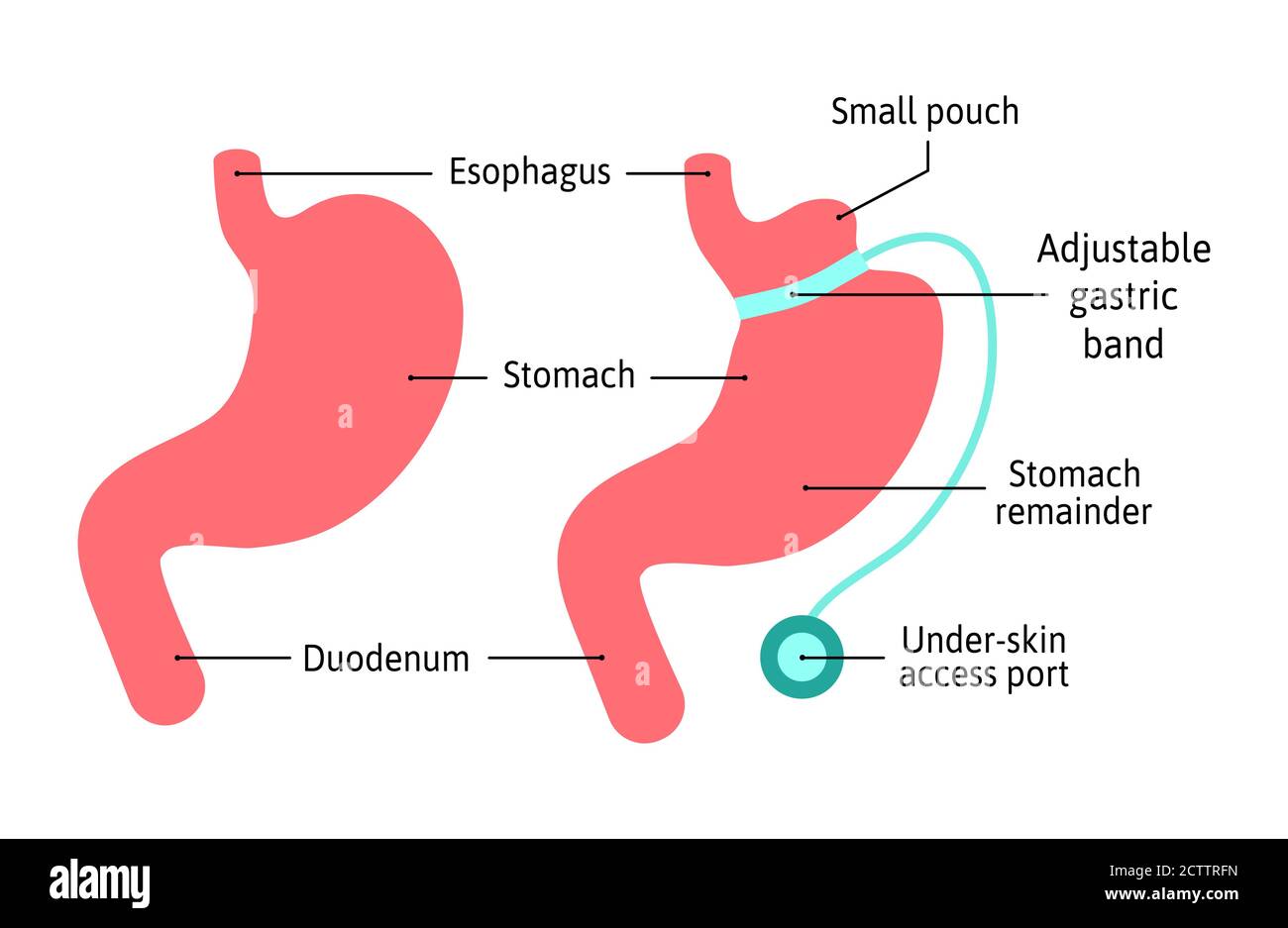 Anatomisches medizinisches Illustrationsdiagramm des Magenbandes. Operation Teile den Magen in zwei Teile mit Band. Menschliche Bauchanatomie isoliert auf weiß Stock Vektor