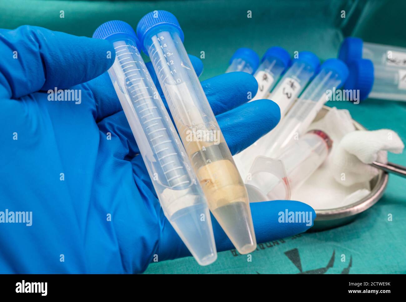 Fläschchen mit Proben von Cerebrospinalflüssigkeit bei Patienten mit transversaler Myelitis nach Injektion mit experimentellem Oxford-Covid-19-Impfstoff auf dem Stockfoto