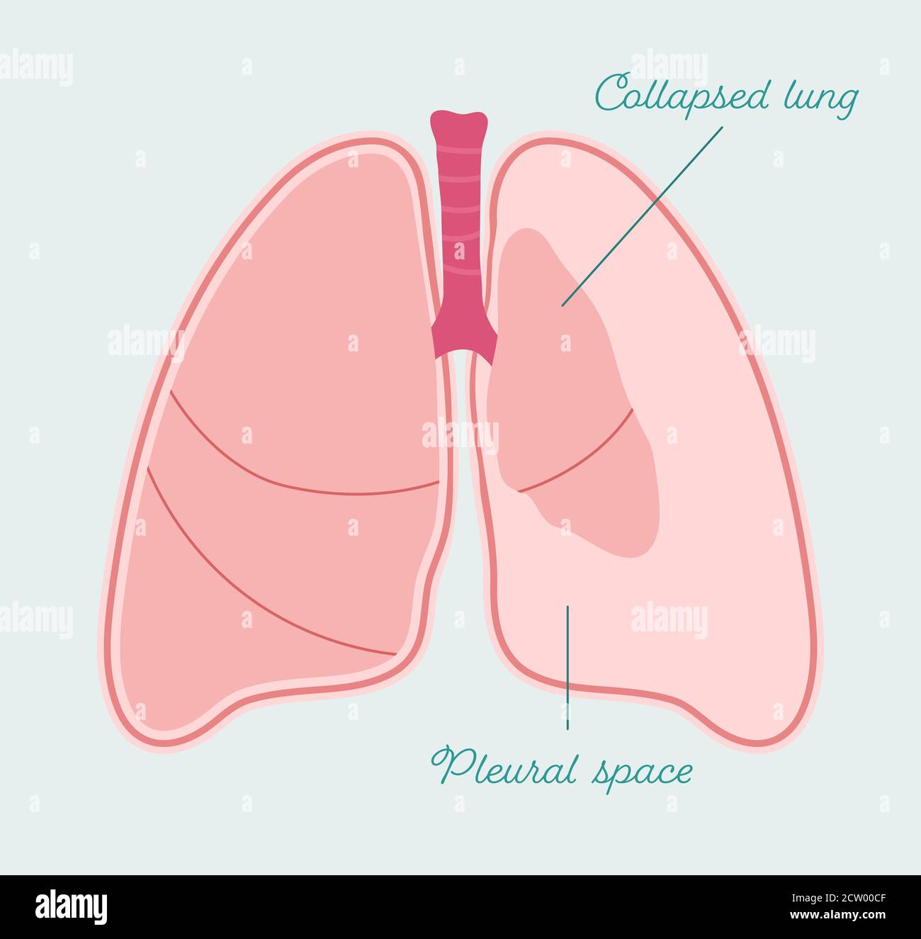 Pneumothorax der menschlichen Lunge. Kollabierte Lunge - Vektor anatomisches Schema Stock Vektor