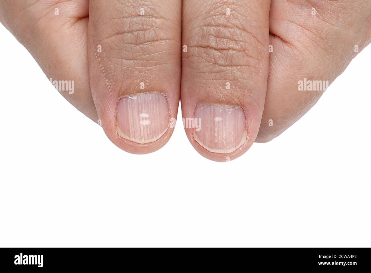 Weiße Flecken und vertikale Kanten an den Fingernägeln Symptome Mangel  Vitamine und Mineralstoffe Stockfotografie - Alamy