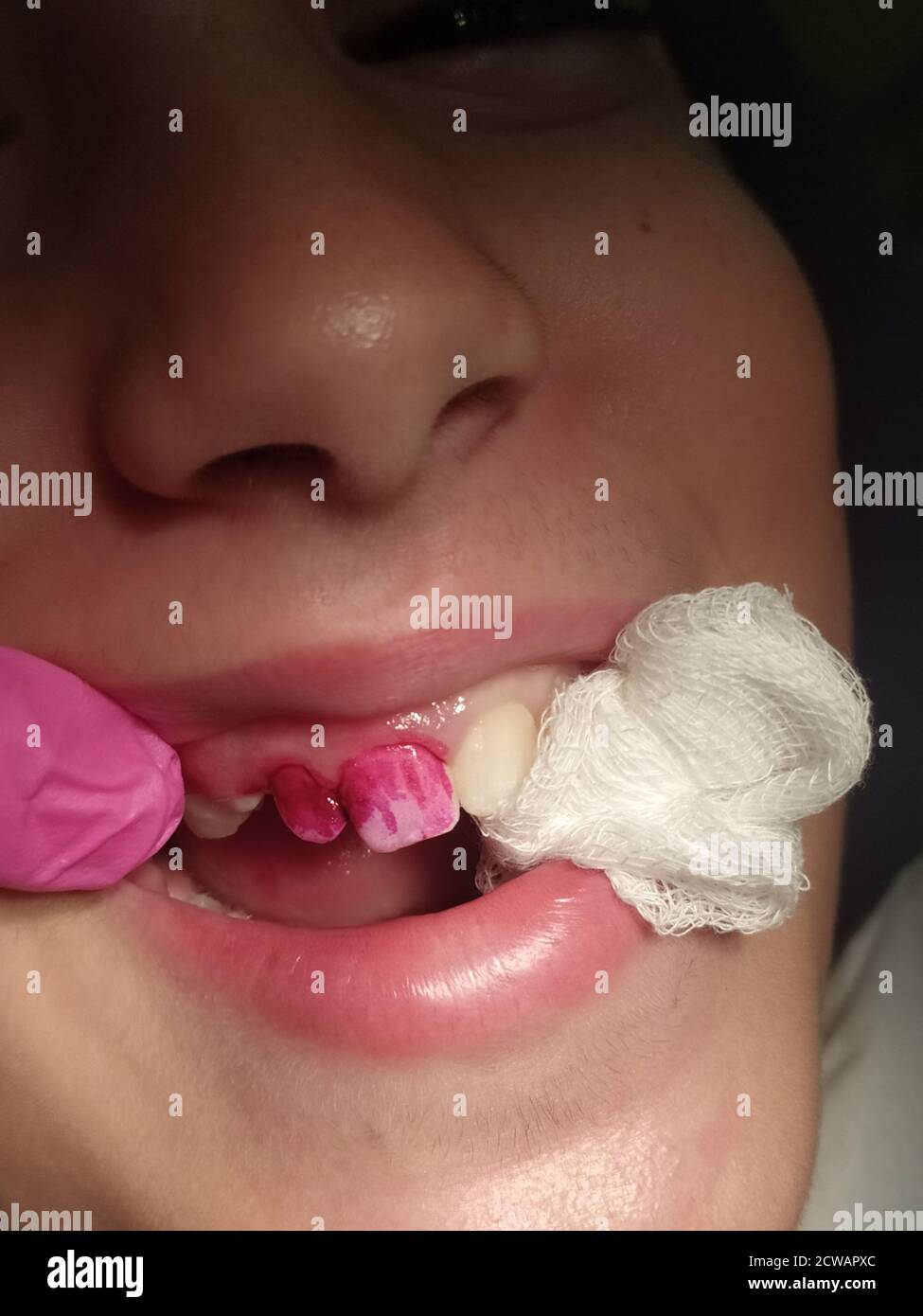 Eine junge Patientin, die von einer Zahnhygienikerin behandelt wird Zähne werden poliert Model Release verfügbar Stockfoto