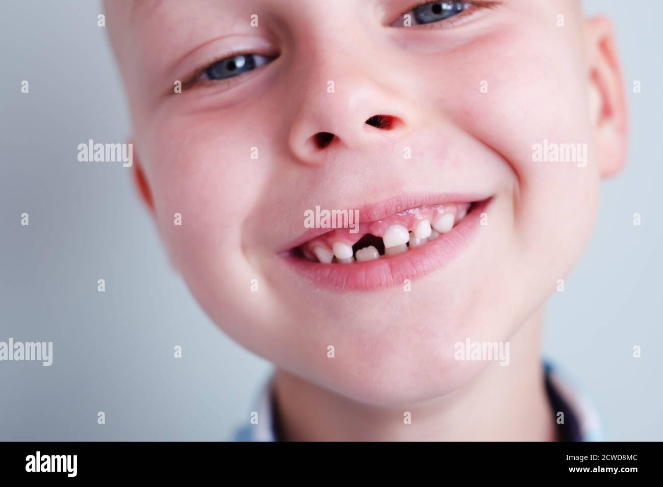 Zahnloch Stockfotos Und Bilder Kaufen Alamy
