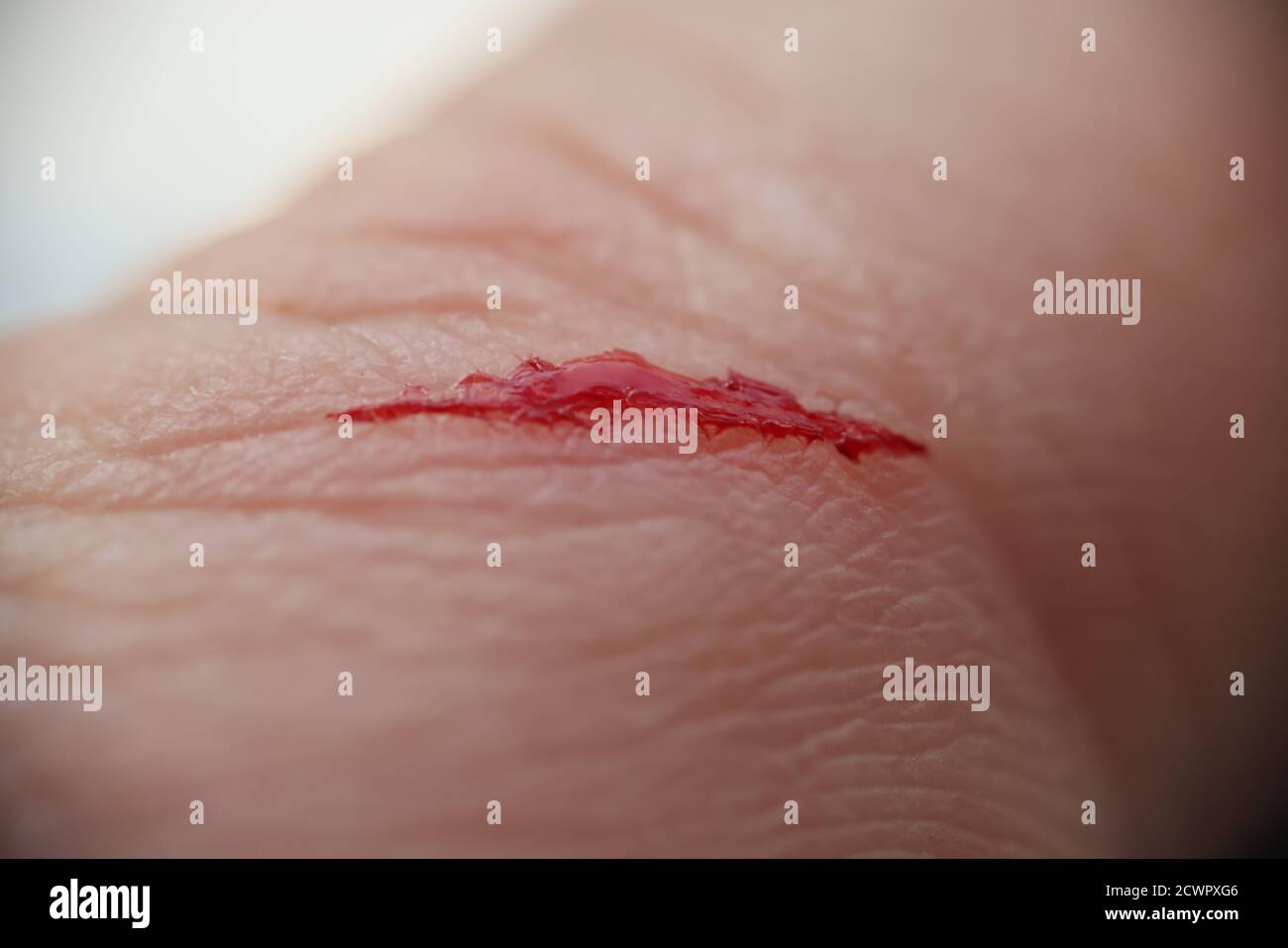 Nahaufnahme der offenen Wunde mit Blut auf der Haut Hand Stockfoto