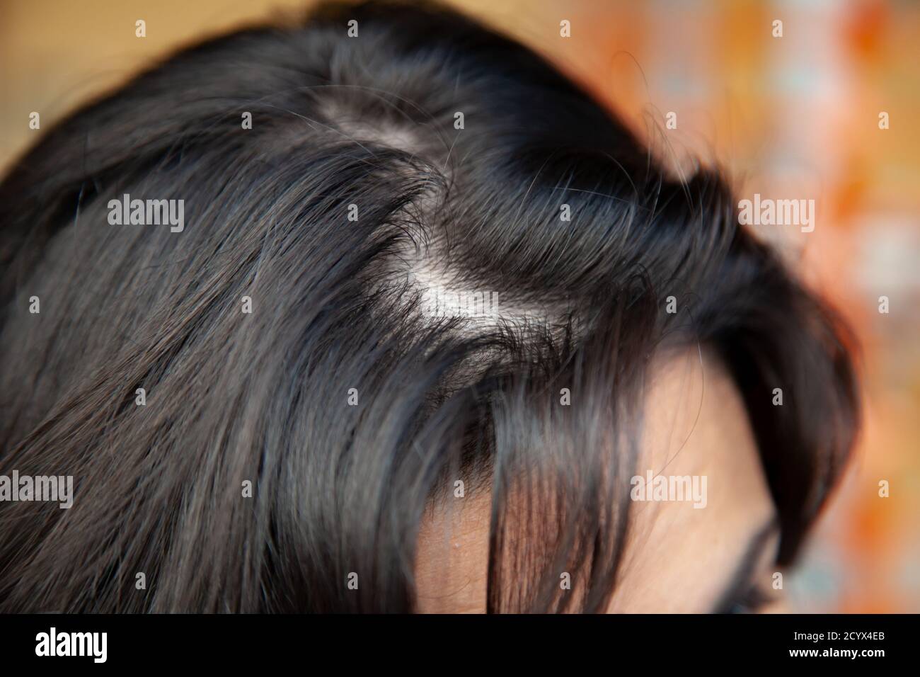 Frau zeigt dünner werdendes Haar in der Nähe der Wurzel mit öligen Haarproblemen. Haarausfall kann mehrere Faktoren haben, einschließlich Genetik, Pathologien und Schwangerschaft. Stockfoto
