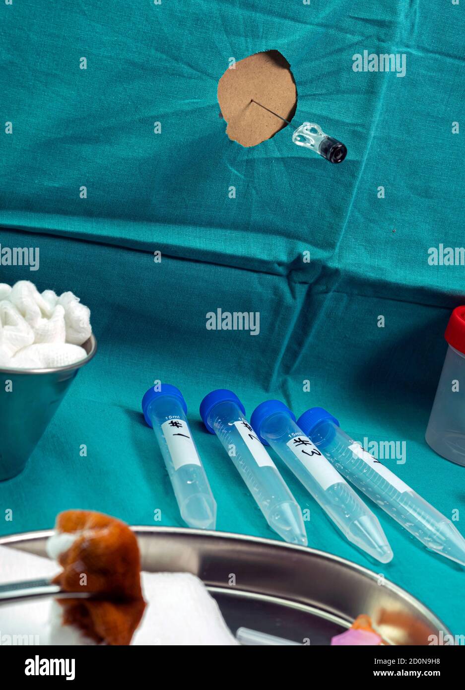 Nadel für Lumbalpunktion zusammen mit Anästhesie und Antibiotika zu Extraktion von Liquor bei Patienten mit transversaler Myelitis nach dem sein inj Stockfoto