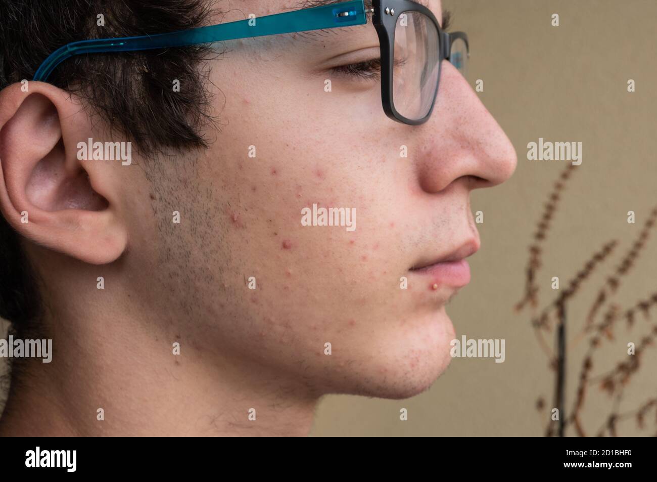 Nahaufnahme Porträt auf der Haut eines jungen kaukasischen Jungen im Pubertal Alter: Auf seiner Haut gibt es mehrere erkennbare Pickel zu verschiedenen Zeiten ihrer Stockfoto
