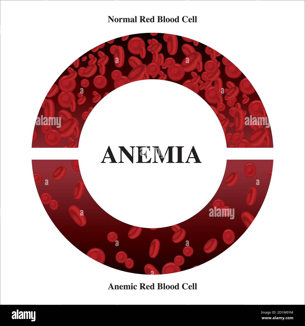Anämie Menge des roten Blutes Eisenmangel Anämie Unterschied der Anämie Menge der roten Blutkörperchen und normale Symptome Vektor Illustration medizinisch. Stock Vektor