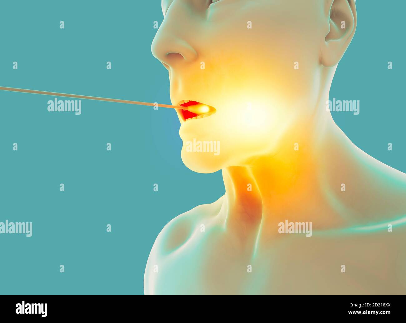 Ein Tupfer im Nasopharyngeal (oder Nasopharyngealkultur) Ist eine Methode zur Entnahme einer klinischen Testprobe von Nasensekrete und Hals Stockfoto