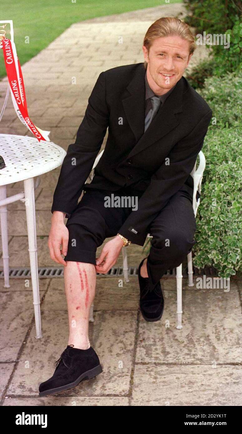 Emmanuel Petit von Arsenal zeigt Verletzungen an seinem Bein, die er  während des gestrigen siegreichen Spiels über Everton erlitten hat, als er  heute (Montag) seinen neu angepassten Anzug modelliert - ein Design