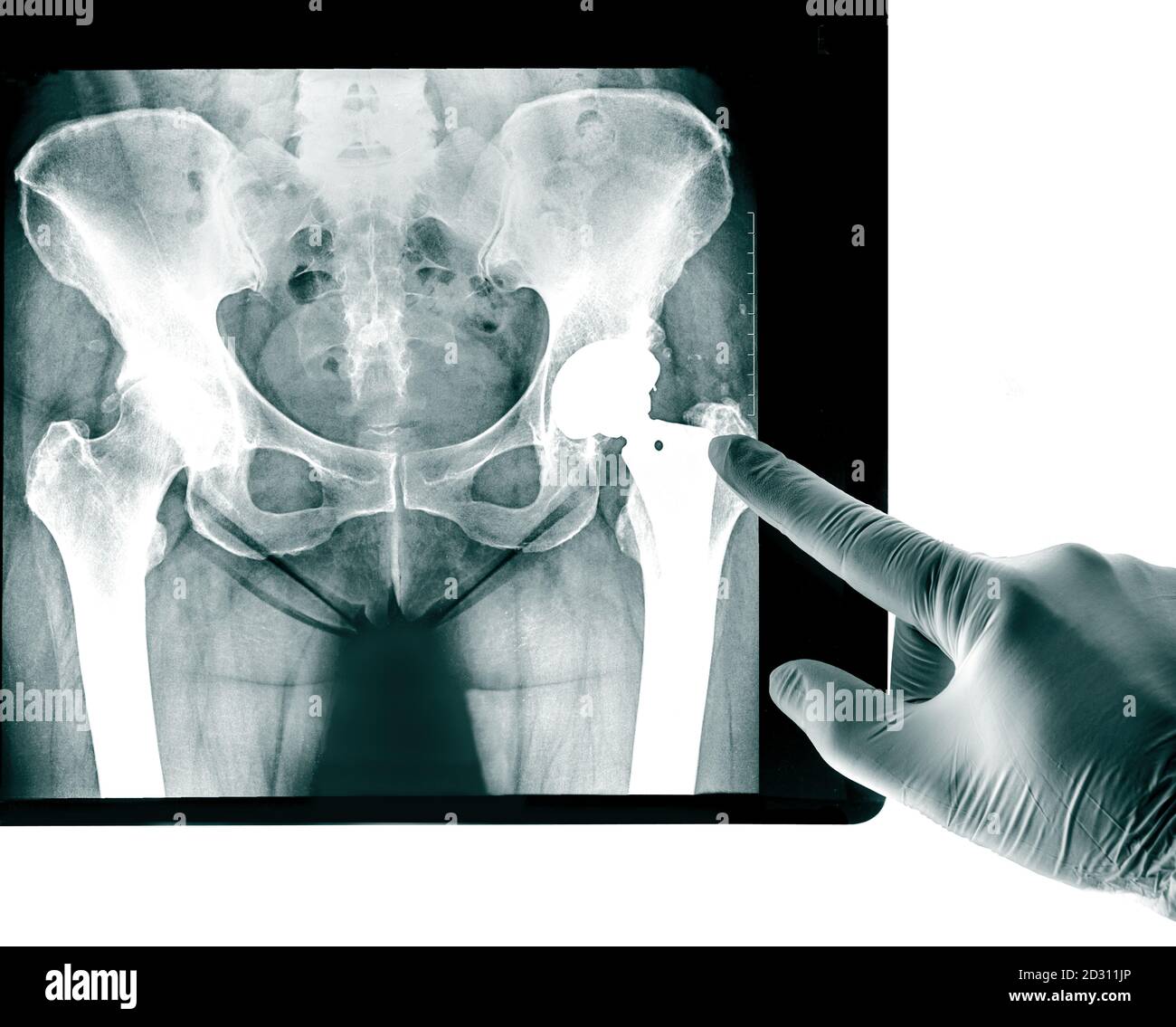 Röntgenaufnahme der Endoprothese des Beckens, der für rheumatische Erkrankungen des Hüftgelenks und rheumatoider Arthritis verwendeten Gelenkhöhle Stockfoto