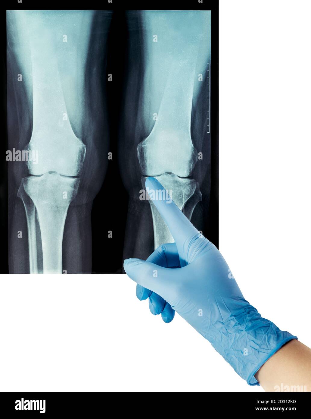 Röntgen rheumatische Erkrankungen und Knie rheumatoide Arthritis zwei Beine Stockfoto