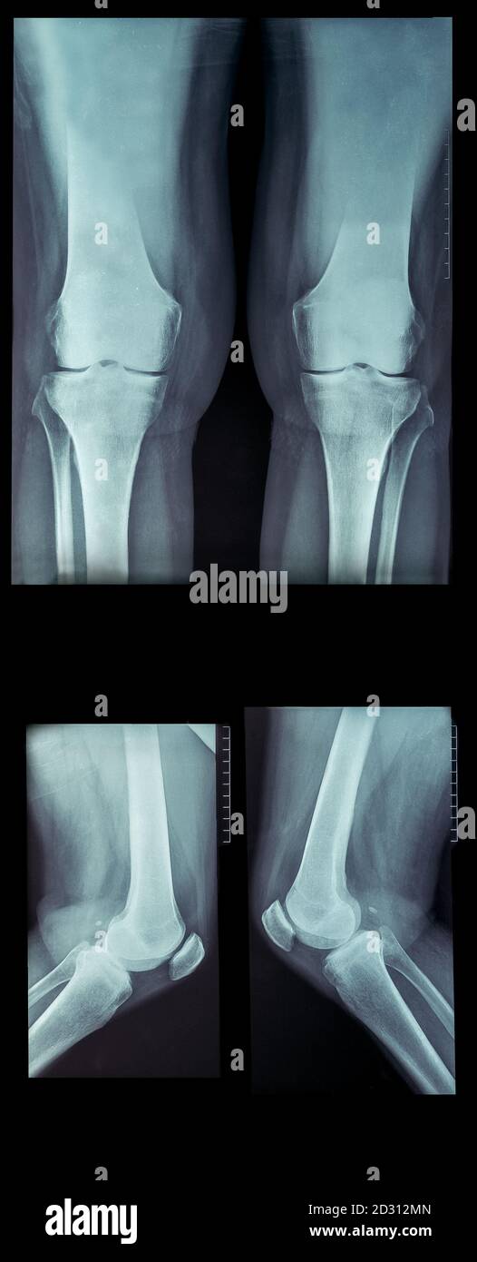 Film X Ray Kniegelenk Bei Arthritis Gicht Rheumatoide Arthritis Septische Arthritis Arthrose Knie Und Leeren Bereich Im Stockfotografie Alamy