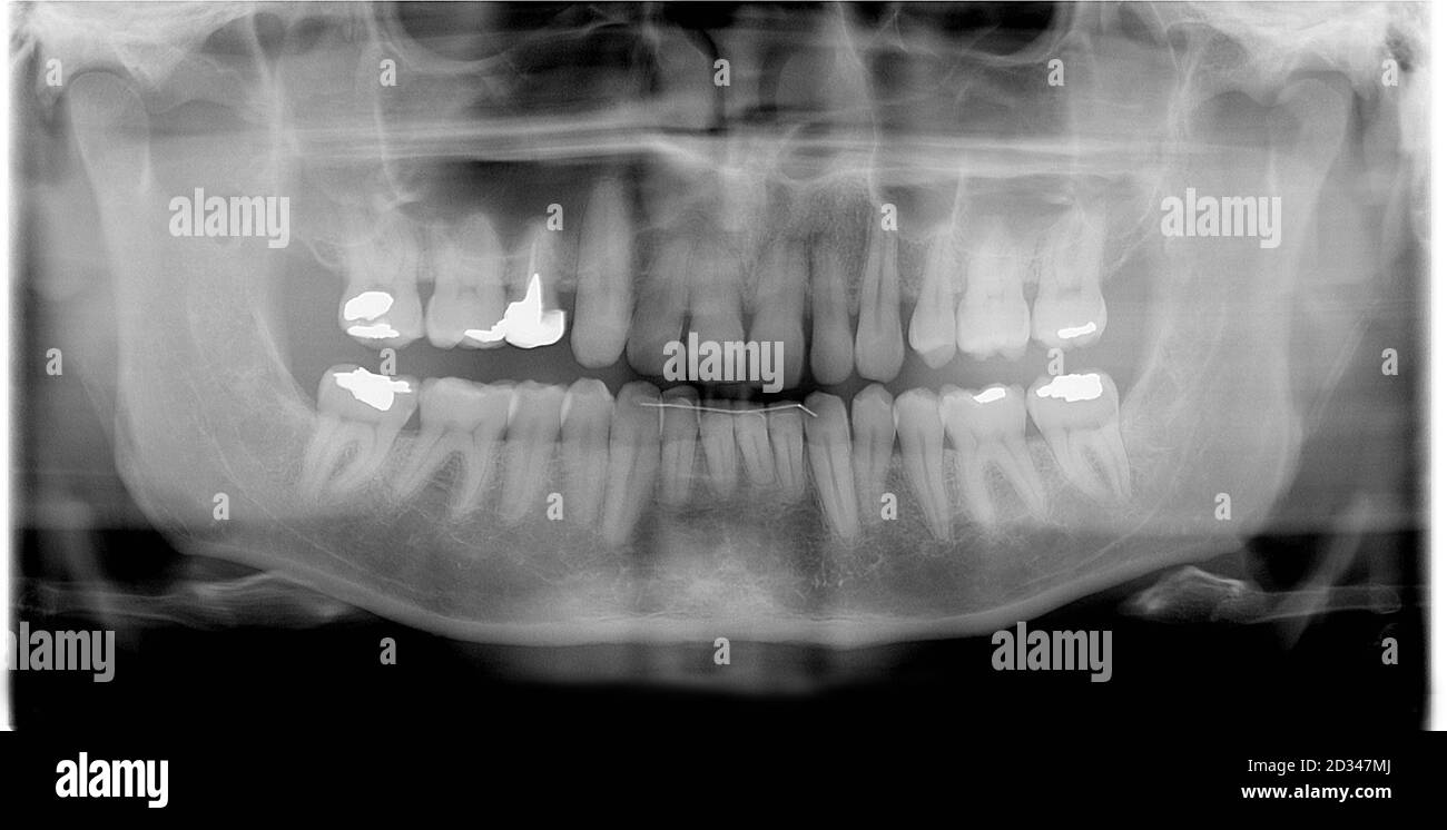 rtg (Röntgen) Foto von menschlichen Zähnen als medizinischen Hintergrund Stockfoto