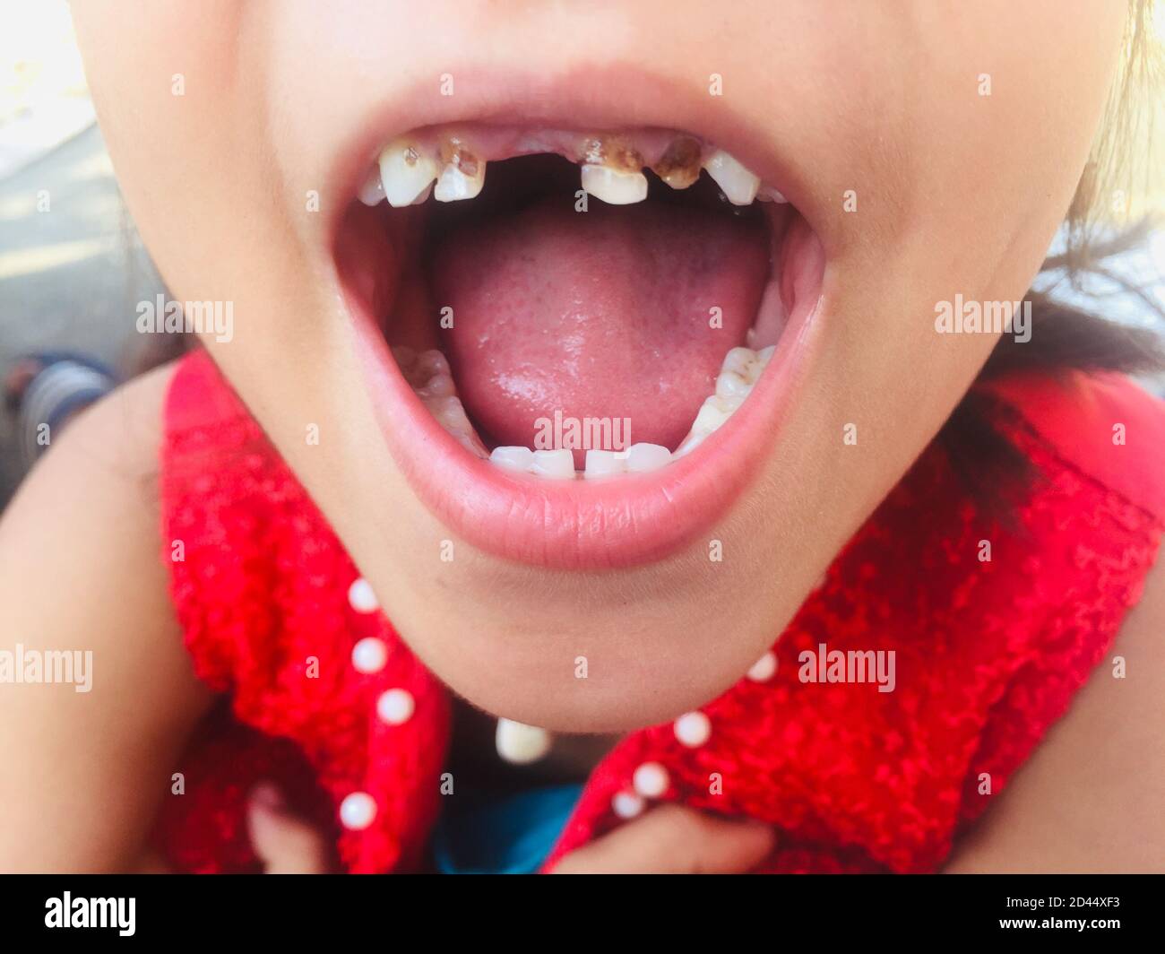 Ein Mädchen mit offenem Mund zeigt ihre Zähne für die Überprüfung ihrer Kavität Infektion und Zahnschmerzen.verfallener Zahn, Zahnproblem und Zahnkrankheit. Stockfoto