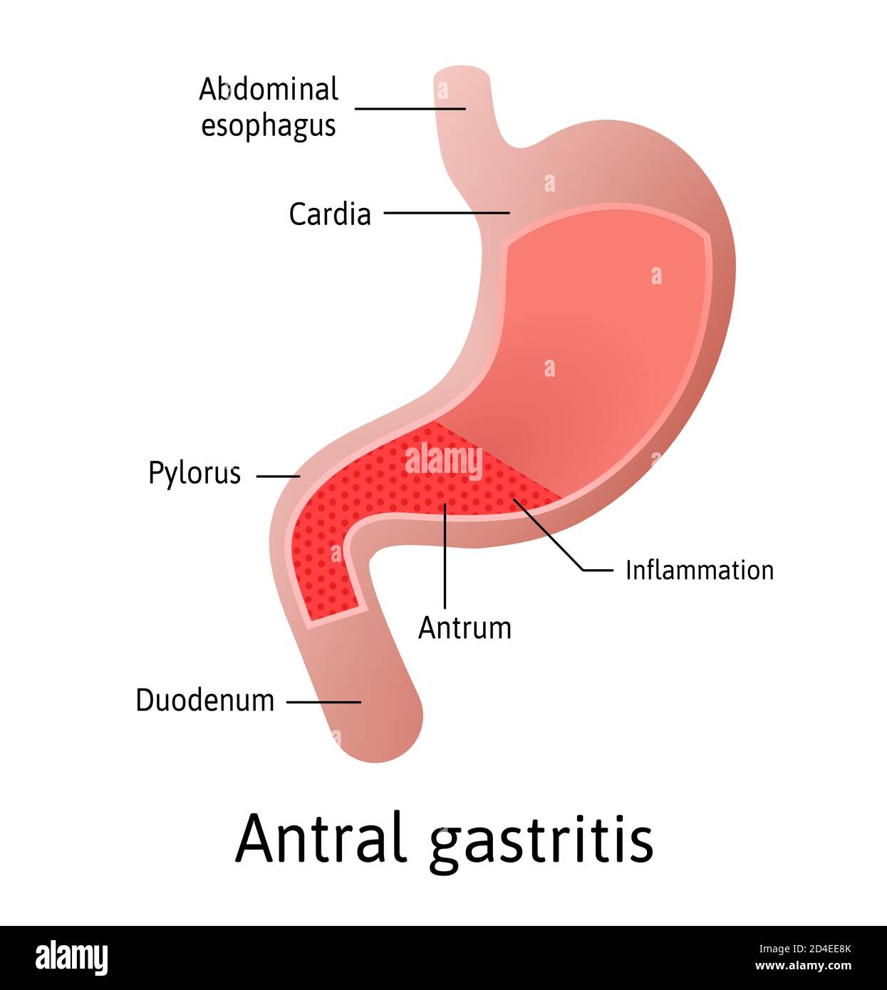 Antral Lage der Gastritis, eine Entzündung der Schleimhaut des Magens. Drei Typen antral, des Körpers und Pangastritis. Medizinischer Vektor Stock Vektor