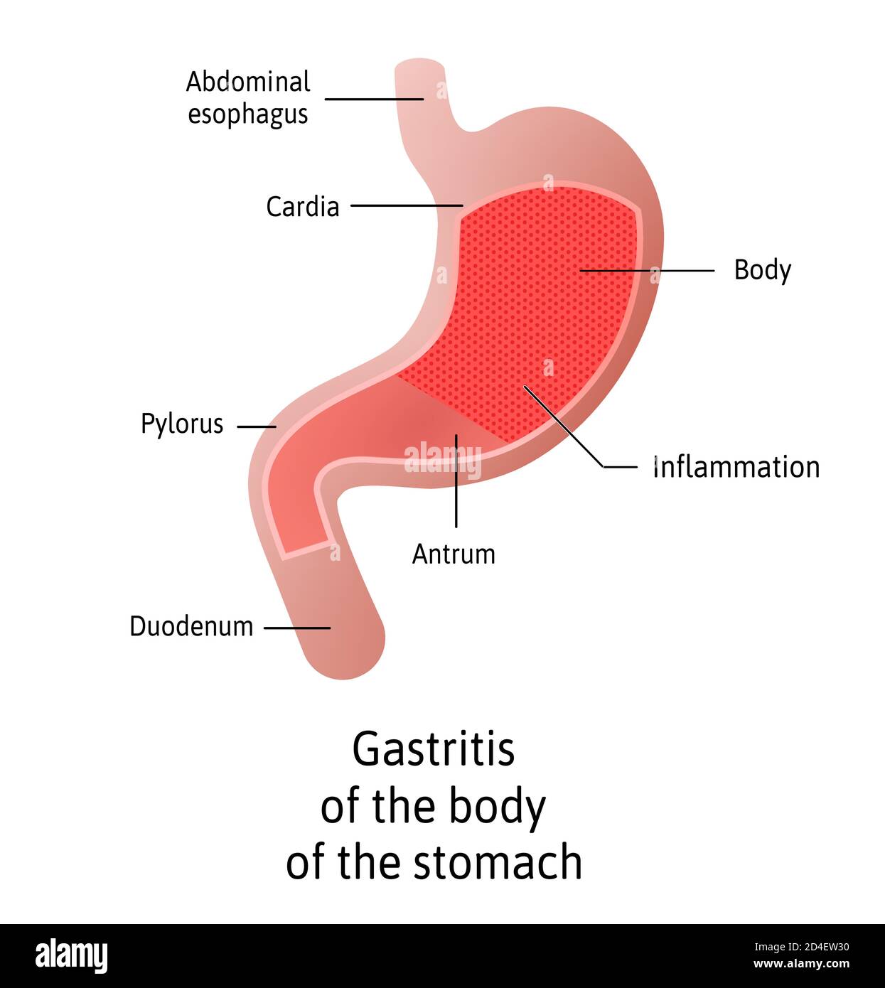 Lage der Gastritis, Körper davon, eine Entzündung der Auskleidung des Magens. Drei Typen antral, des Körpers und Pangastritis. Medizinischer Vektor Stock Vektor