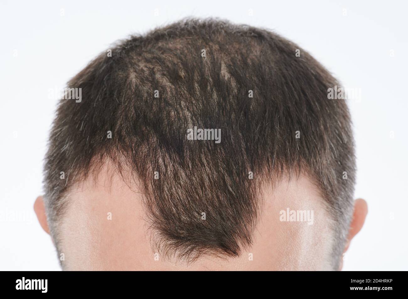 Mann verliert Haare auf dem Kopf aus der Nähe isoliert auf weiß Hintergrund Stockfoto