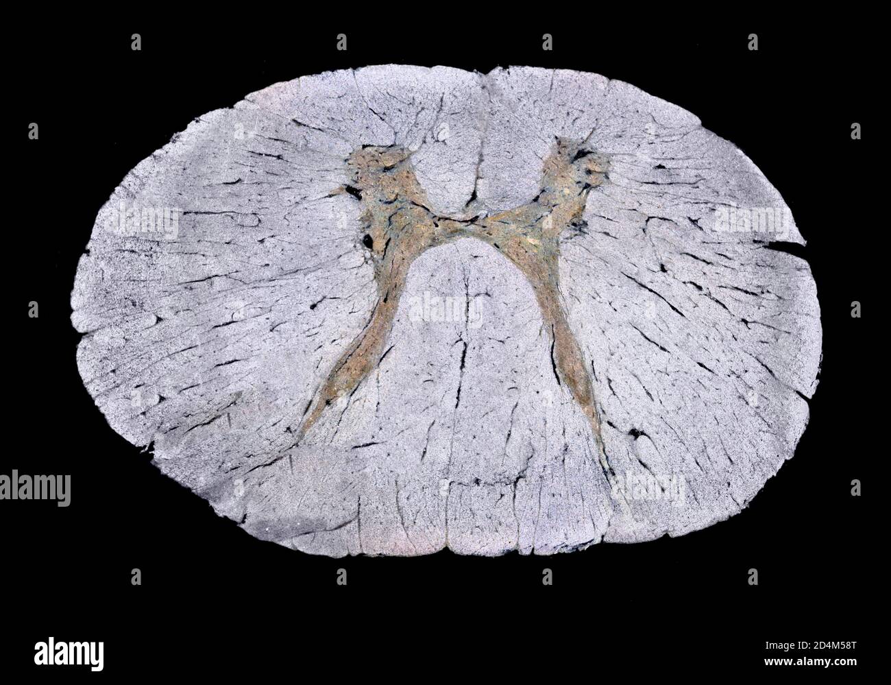 Humanes Rückenmark Halsbereich, infantile Lähmung. Dunkelfeld-Photomikrograph Stockfoto