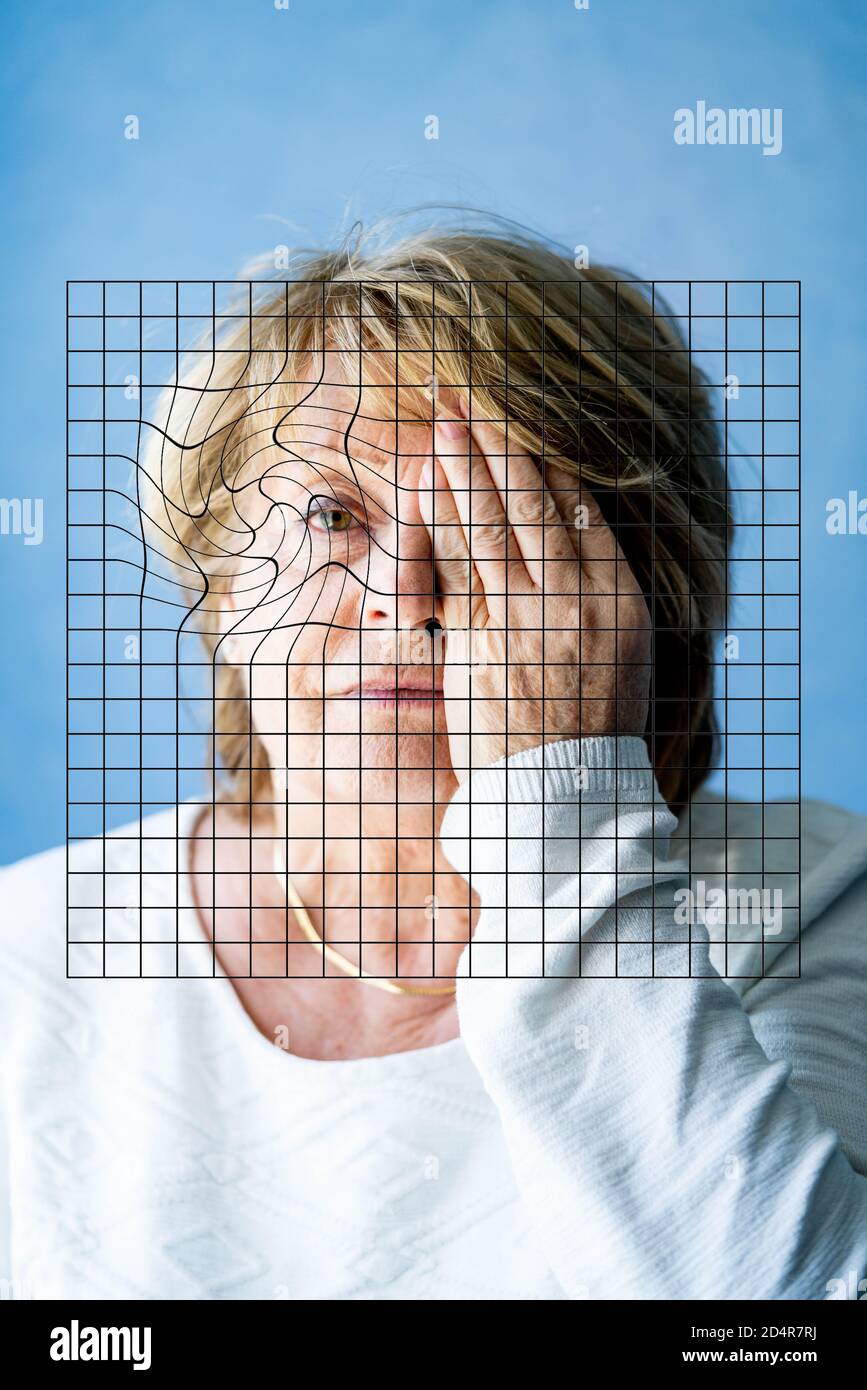 AMD (altersbedingte Makula-Degeneration), Amsler-Gitter. Stockfoto