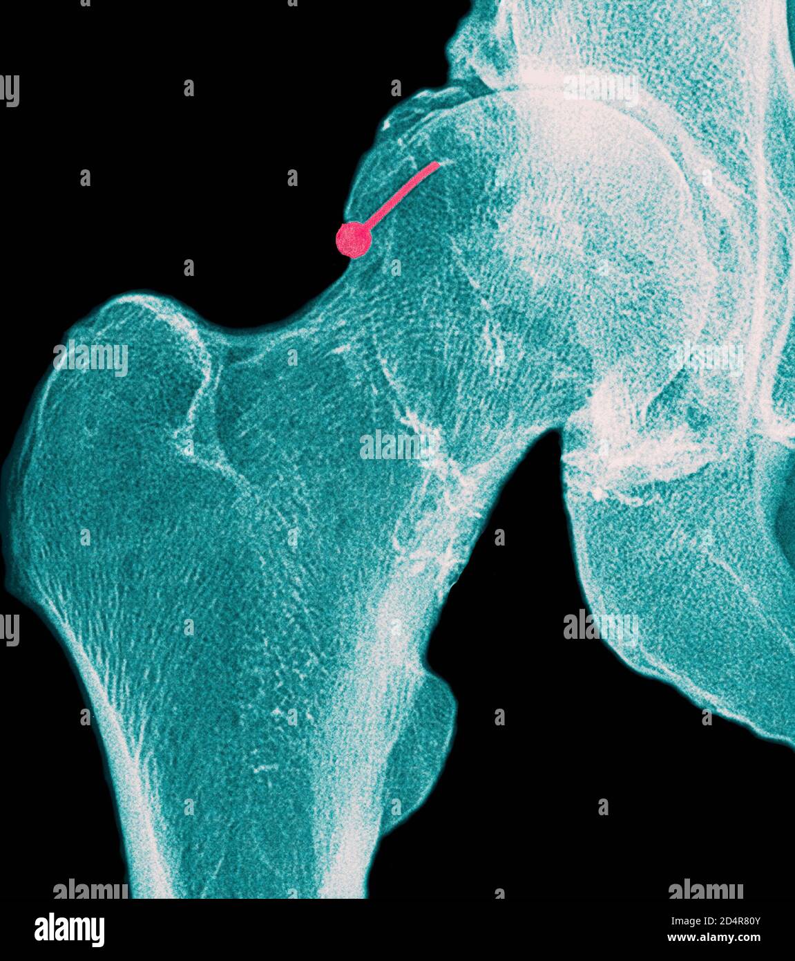 Hip osteoarthritis -Fotos und -Bildmaterial in hoher Auflösung – Alamy