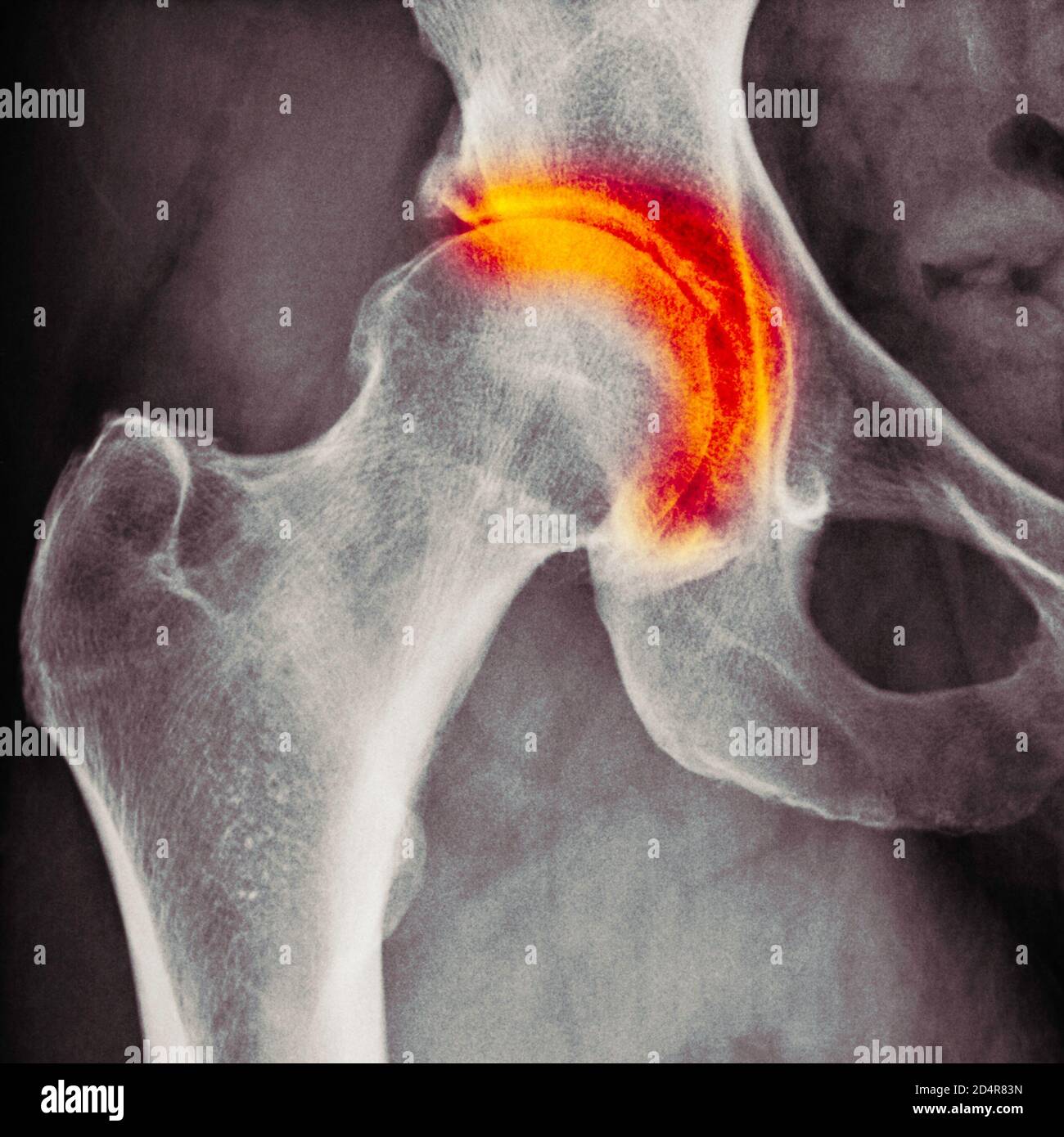 Röntgen zeigt Arthritis der Hüfte, Arthritis ist eine Gelenkerkrankung, die Knorpelzerstörung, Knochenerodieren und Sehnenentzündung verursachen kann. Stockfoto
