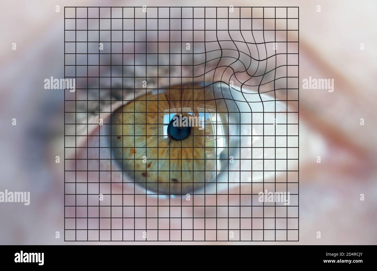 Amsler-Gitters verwendet, um die Makula-Degeneration Verwandte zu Alter (MDRA) erkennen. Stockfoto