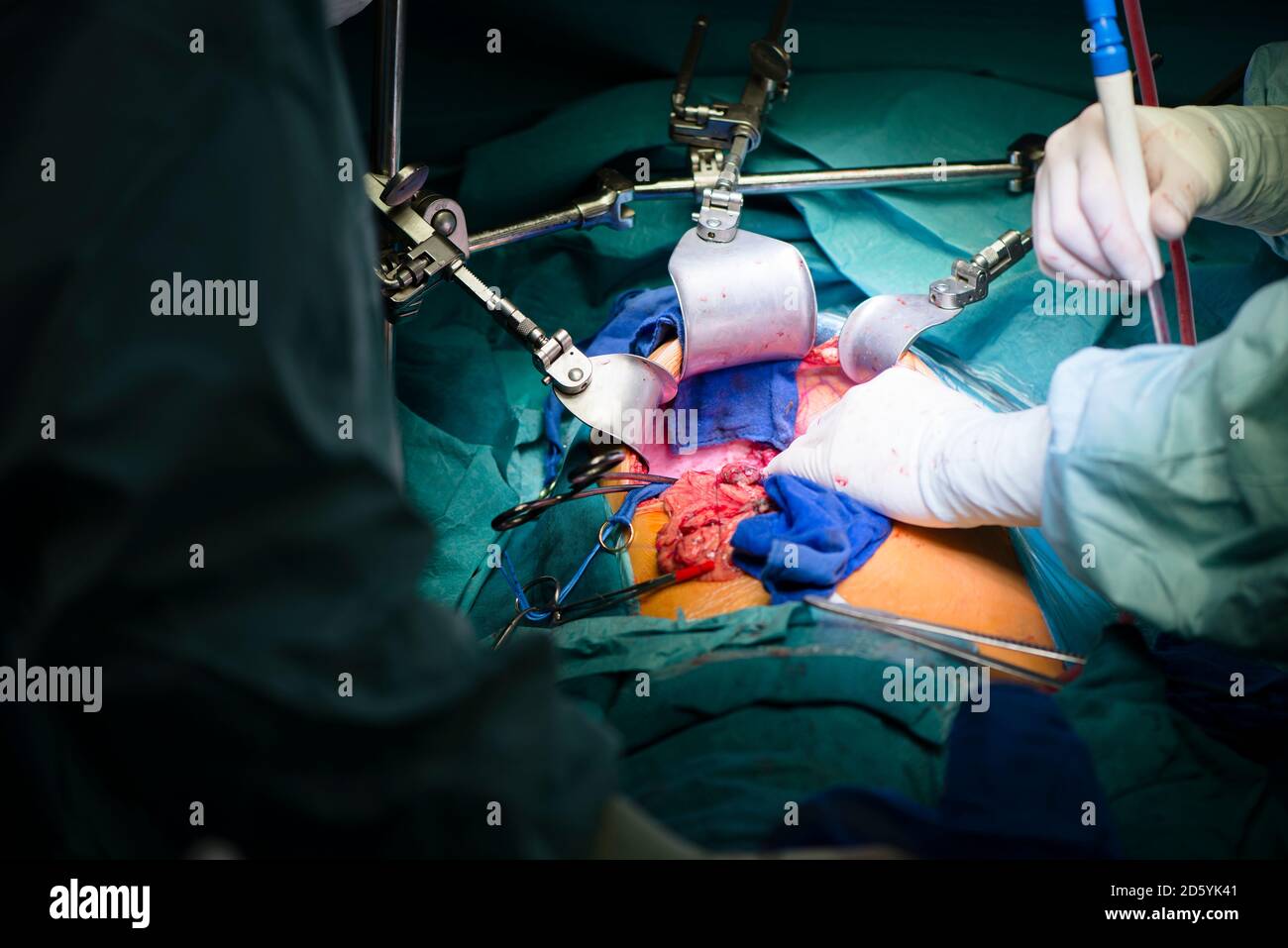 Chirurgen eine Leber Transplantation Stockfoto