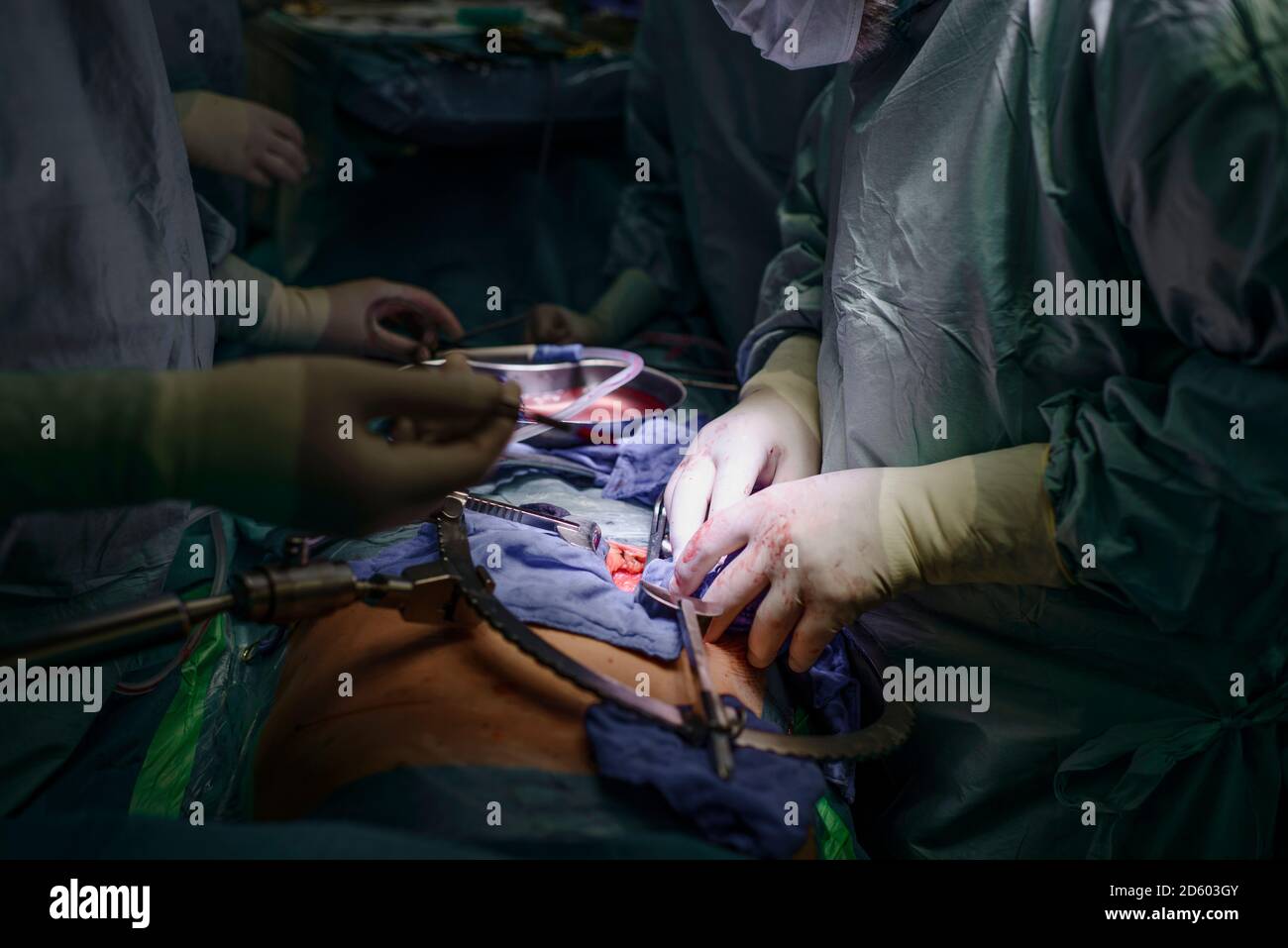 Chirurgen, die eine Niere Transplantation Stockfoto