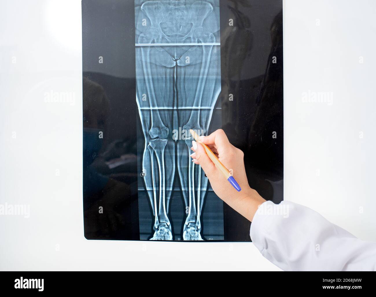 Röntgen des Kniegelenks auf einem Negatoskop, Röntgen als eine Art der Diagnose für die Behandlung von Krankheiten und Verletzungen der Gelenke der Beine Stockfoto