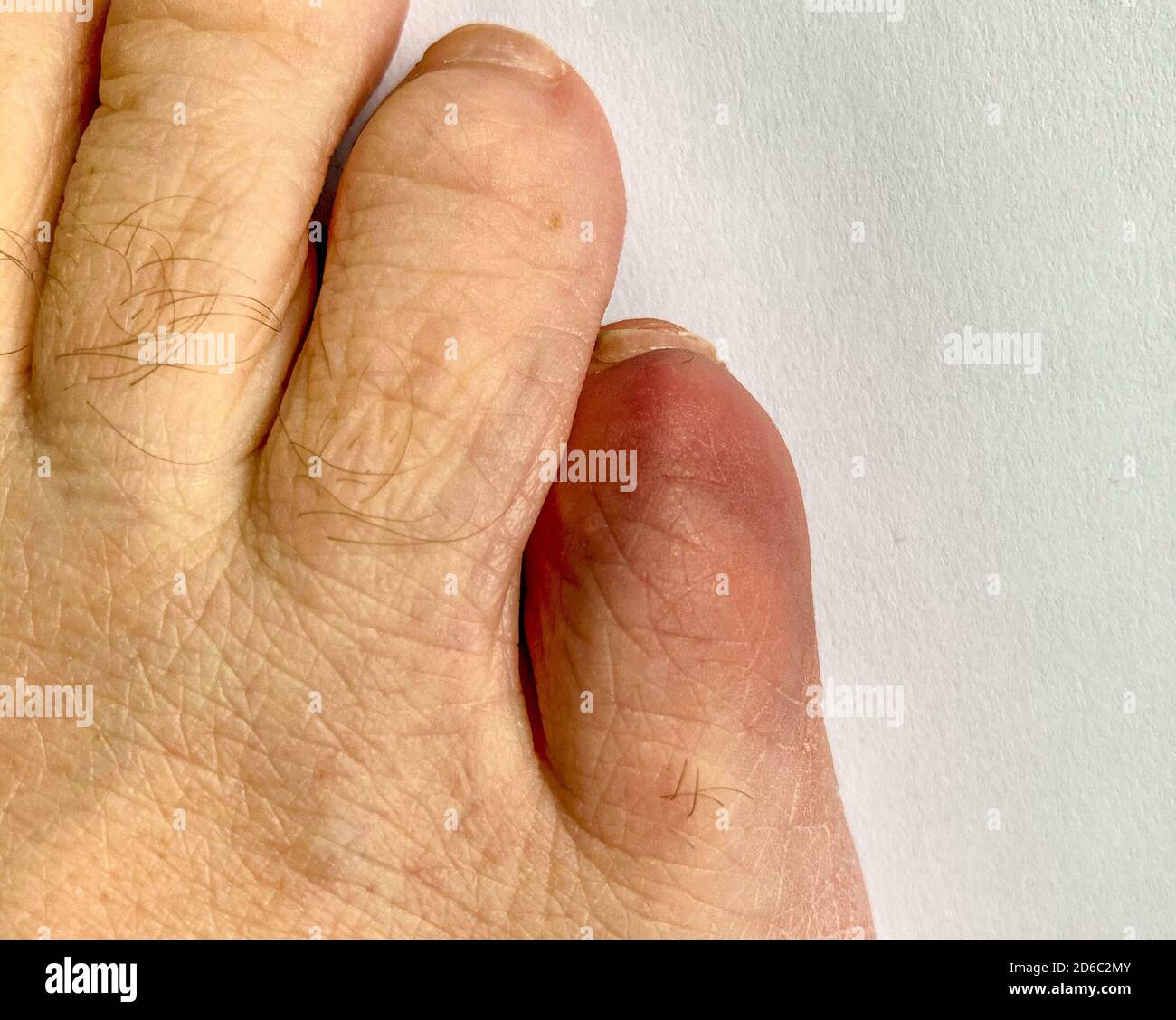 Nahaufnahme der gebrochenen kleinen Zehe eines Senior Mann, der Verfärbung an der Stelle des Traumas angezeigt Von oben nach unten Stockfoto