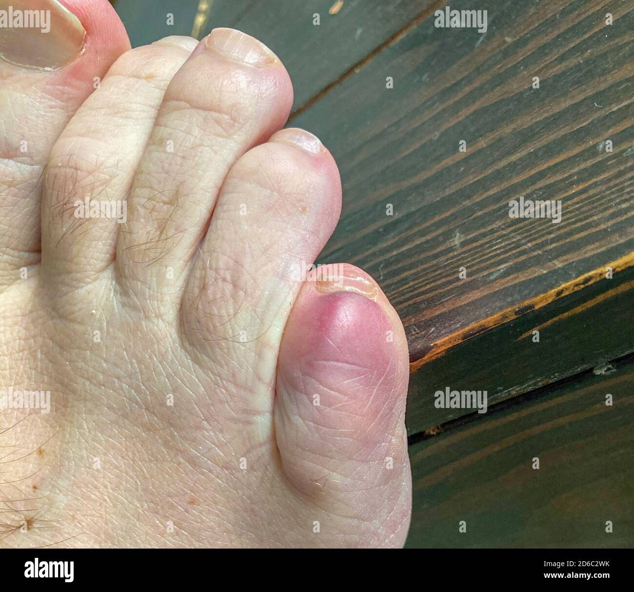 Zerbrochene kleine Zehe eines Mannes in Nahaufnahme Über einem Holzdeck als Folge von stumpfer Kraft Trauma auf den Knochen Stockfoto