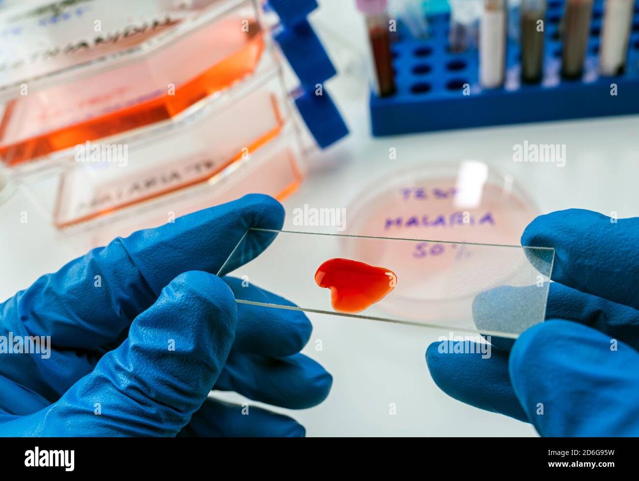 Wissenschaftler untersucht Blutprobe von kranken Menschen mit Malaria im Labor, konzeptuelles Bild Stockfoto