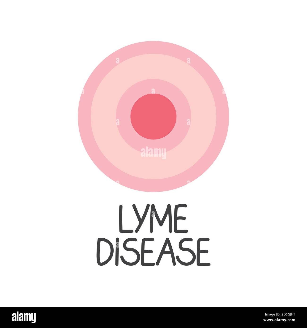 lyme-Borreliose Text und Erythema migrans Ausschlag Konzept- Vektor Illustration Stock Vektor