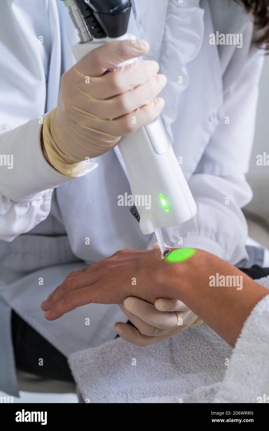 Permanente Laser-Haarentfernung der Hände und Unterarme, COSEM Zentrum Paris. Stockfoto