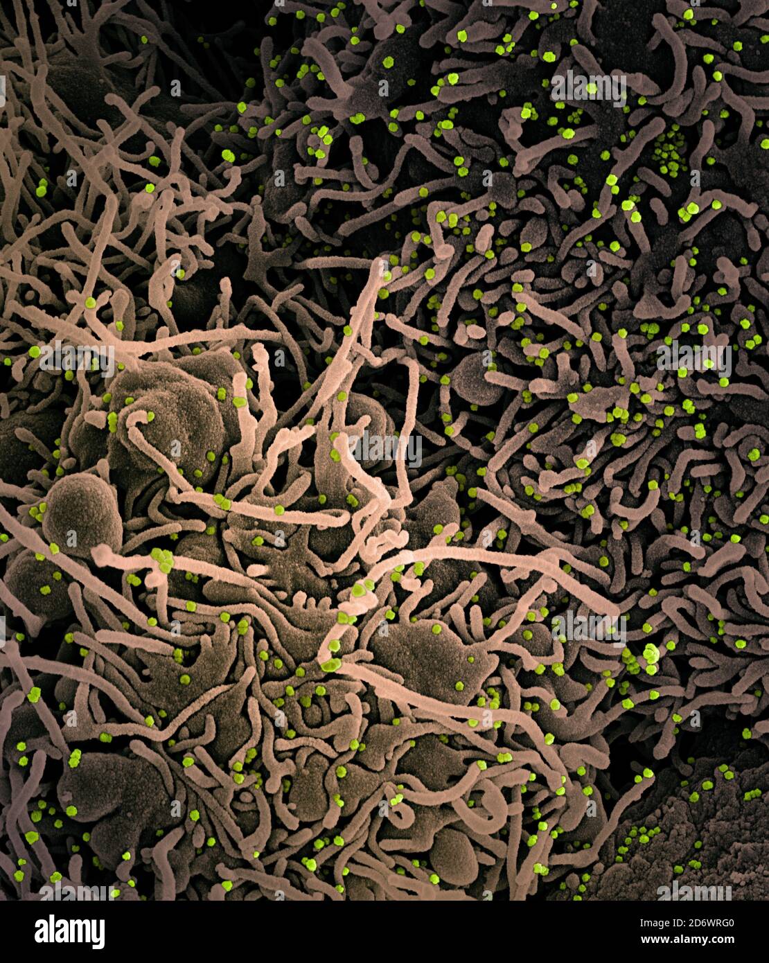 Koloriertes Rasterelektronenmikrograph einer VERO E6-Zelle (tan) mit länglichen Zellprojektionen und Anzeichen einer Apoptose nach einer SARS-Infektion Stockfoto